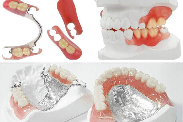 自費診療の入れ歯