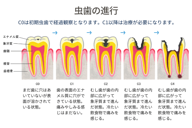 虫歯の進行