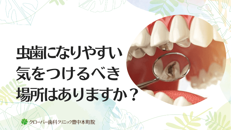 虫歯になりやすい気をつけるべき場所はありますか？