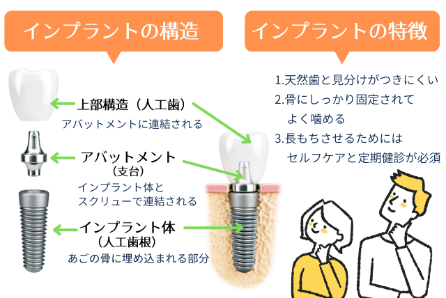 インプラントの構造と特徴