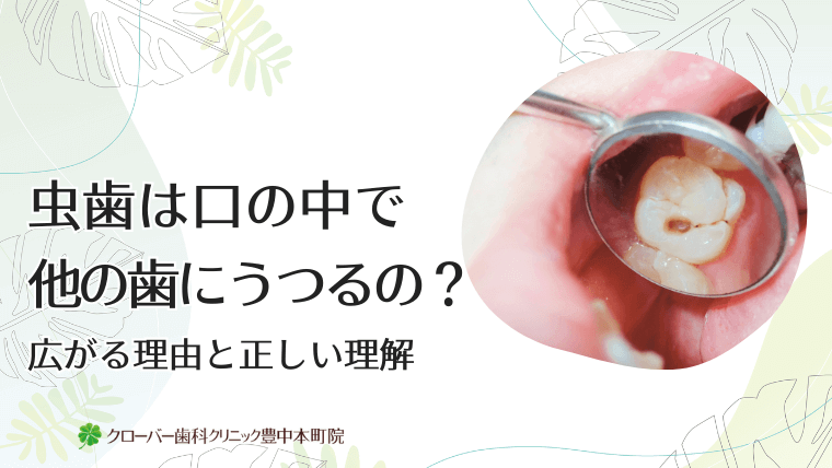 虫歯は口の中で他の歯にうつるの？広がる理由と正しい理解