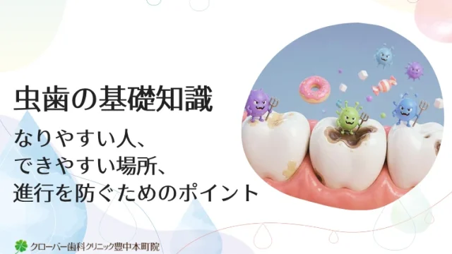 虫歯の基礎知識｜なりやすい人、できやすい場所、進行を防ぐためのポイント