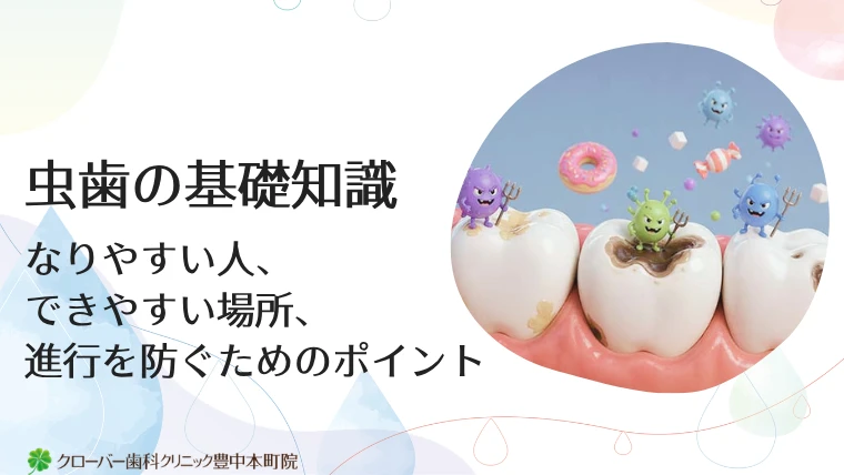 虫歯の基礎知識｜なりやすい人、できやすい場所、進行を防ぐためのポイント