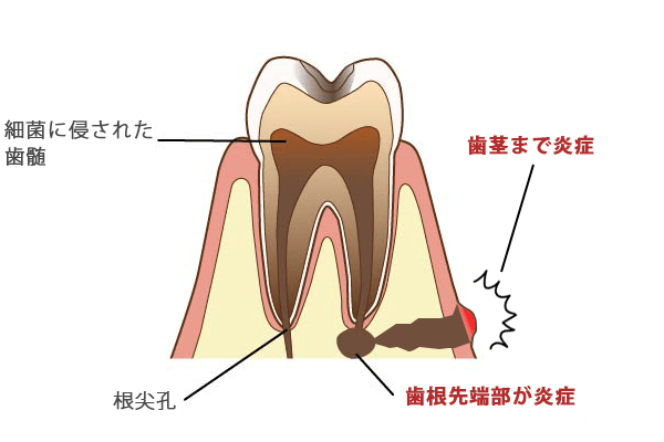 歯根歯周炎