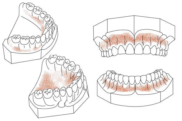 口腔内粘膜の痛点の分布