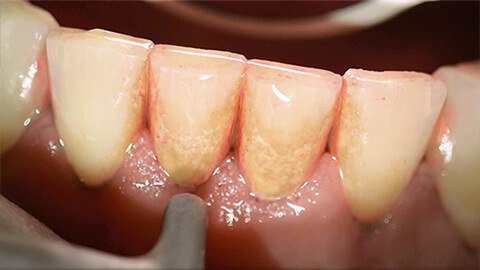 早期歯石の除去