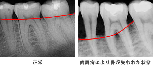 正常な状態と歯周病により骨が失われた様子のレントゲン比較